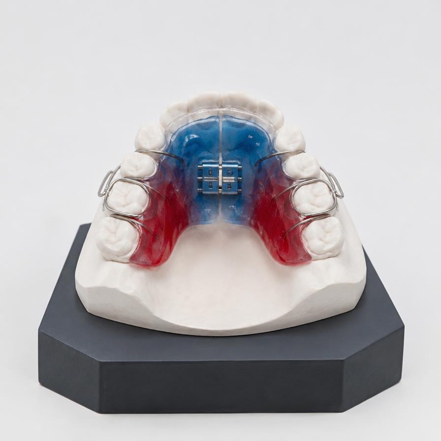 Dependability — Planet Ortho International Custom expander appliance fitted to a model
